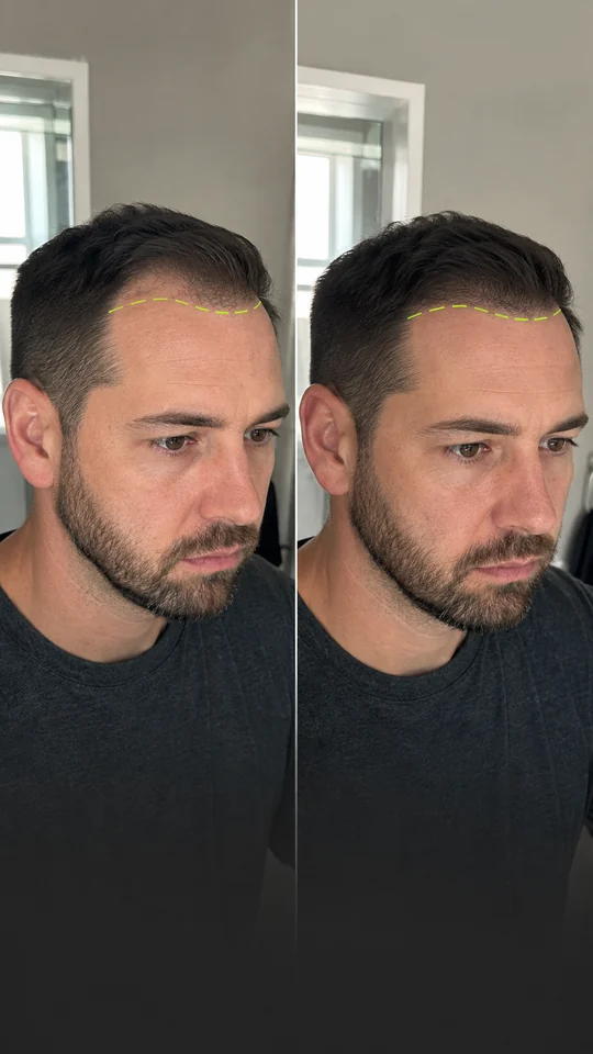 Controlled before-and-after comparison of a man's hairline